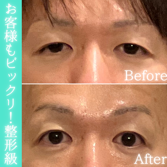 整形級!目の開きビフォーアフター