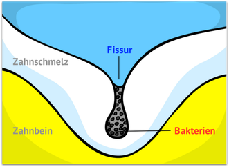 Bakterien in der Fissur (© wigerio)