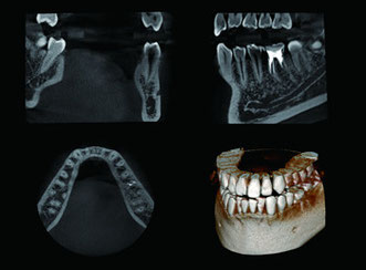 歯科用CTで歯周病の進行が分かります。