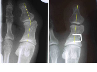 OP bei Hallux valgus