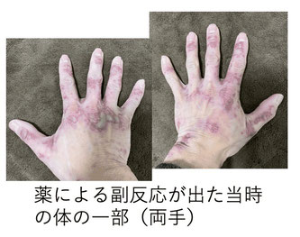 院長も偏頭痛に悩み、頭痛薬の飲み過ぎでこのような副反応が出てしまいました