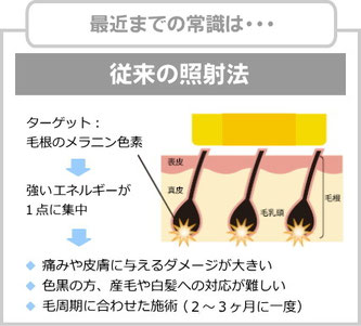 従来の脱毛の照射法