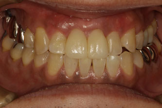 歯茎の再生治療で歯茎の回復後にセラミック治療