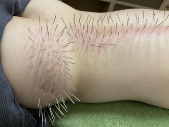 島原唯一の痛み専門院 痛み専門の整体院 鍼灸サロンacus アクス