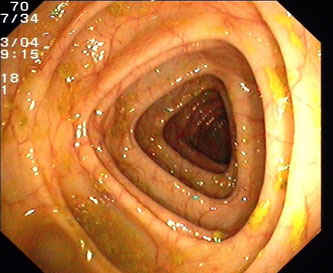 Endoskopische Untersuchung des Colon transversum (Normalbefund).  Bildquelle: Joachim Guntau (=J.Guntau) wikipedia.org • CC-BY-SA-3.0