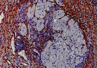 Aktivierte Fibroblasten (braun) und Entzündung (dicht nebeneinanderliegende kleine blaue Kerne) in der Vernarbung eines zirrhotischen Knotens UMM