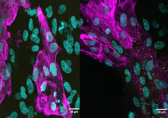 © ultivierte humane Herzmuskelzellen: (links) nicht infiziert, (rechts) infiziert mit der Omicron Subvariante BA.1. Virales Spike-Protein wird in den gelben Punkten sichtbar