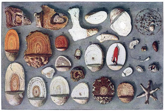 Sammlung von Nieren- und Harnblasensteinen Wikipedia • Max Brödel • Public domain