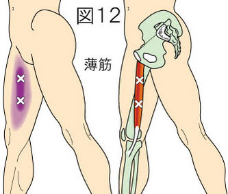 薄筋トリガーポイントによる大腿内側の痛み