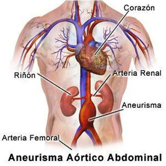 Aneurisma aórtico abdominal, esquema simplificado.