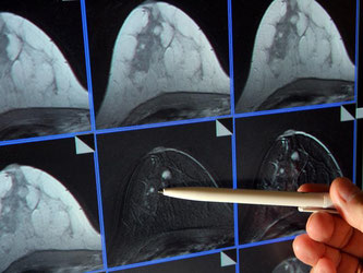 Das Mammografie-Screening in Deutschland trägt weiter dazu bei, dass mehr Frauen mit Brustkrebs ihre Brust behalten können und bessere Heilungschancen haben. Foto: Jan-Peter Kasper