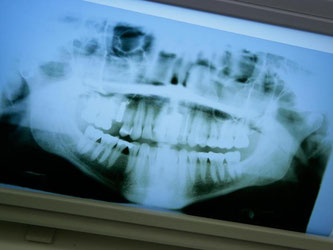 Ohne Röntgenbild können Zahnärzte Befunde oft nicht klar einschätzen. Trotzdem sollten Patienten nachfragen, ob das Röntgen im Einzelfall wirklich nötig ist. Foto: proDente e.V./Johann Peter Kierzkowski