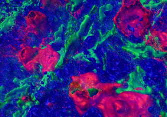 Detaillierte dreidimensionale Darstellung mehrerer rot markierter CD30-positiver Lymphozyten in einem entzündeten Lymphknoten. Aktinfilamente, die das Gewebe durchziehen, sind zur Abgrenzung grün markiert. Die blaue Färbung markiert andere Zellen. ©