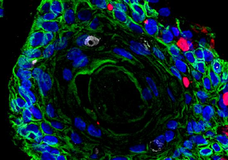 Ektozervikale, geschichtete Plattenepithel-Organoide, die von Patientinnen stammen (grün). Rote Bereiche markieren eine Infektion mit Chlamydia trachomatis. AG Chumduri Universität Würzburg