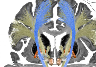 Die Stimulation der blauen Trakte ging mit einer Verbesserung der Symptomatik bei Patienten mit zervikaler Dystonie einher, die Stimulation der gelbfarbenen Trakte bei der Patientengruppe mit generalisierter Dystonie.