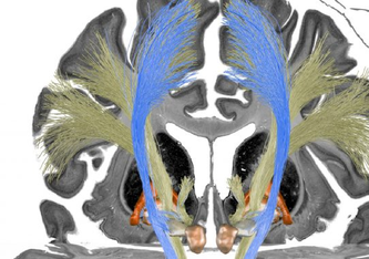 Die Stimulation der blauen Trakte ging mit einer Verbesserung der Symptomatik bei Patienten mit zervikaler Dystonie einher, die Stimulation der gelbfarbenen Trakte bei der Patientengruppe mit generalisierter Dystonie. 