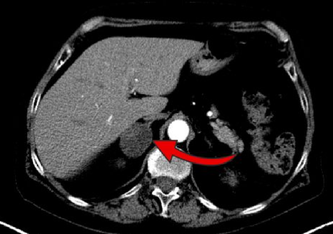 Das MRT zeigt einen drei Zentimeter großen Nebennierentumor auf der rechten Seite. 80 bis 90 Prozent dieser Tumore, die meist zufällig entdeckt werden, sind gutartig. UKW UKW