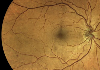 Der Augenhintergrund des Menschen ist gut durchblutet. Wenn man die Gefäße durch die Augenlinse fotografiert, können neuronale Netze anhand der Aufnahmen bestimmte Krankheiten erkennen. Mueller, S./Wintergerst, M.W.M. et al. 