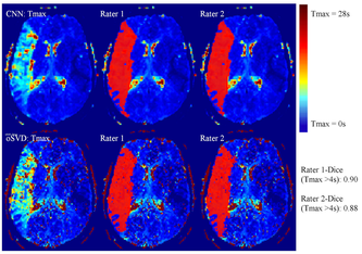 Hirn-Perfusionskarte; Oben mit Convolutional Neural Network (CNN) und unten mit der klassischen Methode eines Patienten mit akutem Hirnschlag. Insel Gruppe