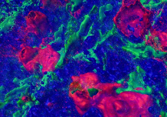 Detaillierte dreidimensionale Darstellung mehrerer rot markierter CD30-positiver Lymphozyten in einem entzündeten Lymphknoten. Aktinfilamente, die das Gewebe durchziehen, sind zur Abgrenzung grün markiert. Die blaue Färbung markiert andere Zellen. © 