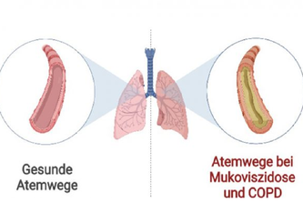 Die Atemwege von Patienten mit Mukoviszidose und COPD sind mit zähem Schleim verstopft. Forschende des Deutschen Zentrums für Lungenforschung fanden heraus, dass die Verschleimung zu einer chronischen Entzündung der Atemwege beiträgt.