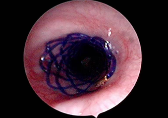 Atemweg-Stent in der Luftröhre
