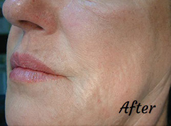 Wrinkle reduction after profhilo treatment