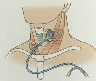 頸部聴診法で聴診器を当てる頸部の位置