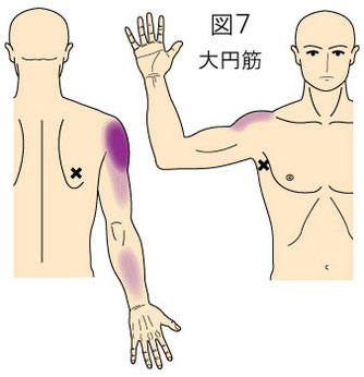 大円筋トリガーポイントによる肩、上腕、前腕の痛み