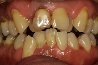 歯並びを審美歯科で治療