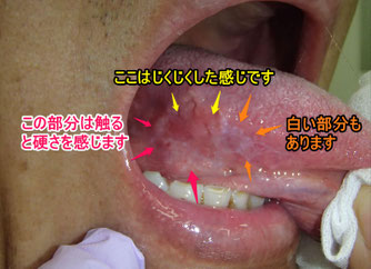 舌　できもの　腫瘍