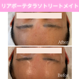 リアボーテ　ビフォーアフター