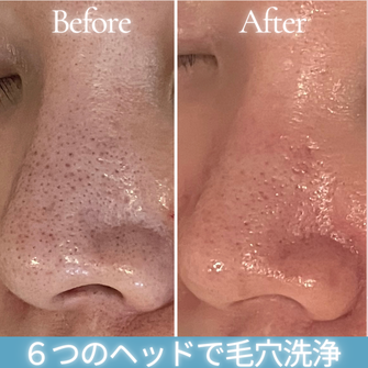 ハイドラフェイシャル　角質ケア　ビフォーアフター