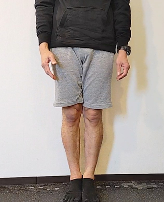 O脚矯正ビフォー