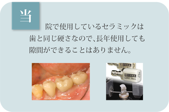 当院で使用しているセラミックは歯と同じ硬さなので、長年使用しても隙間ができることはありません。