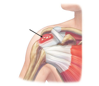 Kalk in der Supraspinatussehne