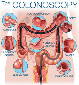 Colonoscopy is performed due to Ulcerative Colitis, Crohn's Disease, Appendicitis, diverticulitis, cancer, polyps and adhesion's. CPM Advanced Suurgical Specialists have performed thousands of colonoscopy procedures in Newnan, Georgia.  