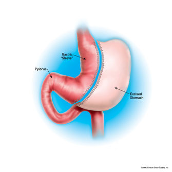During sleeve gastrectomy surgery, 60 to 85% of the stomach is removed creating the shape of the sleeve.