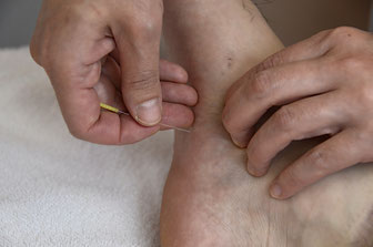 足の裏に鍼灸施術をしている写真