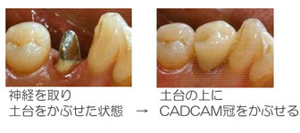 白いかぶせ　CADCAM