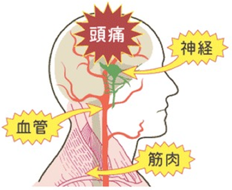 頭痛の原因は、筋肉の硬直による血管と神経の圧迫です。