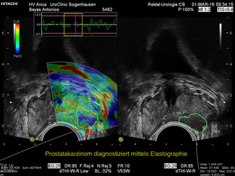 Ultraschall - Elastographie