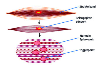 uitleg triggerpoint
