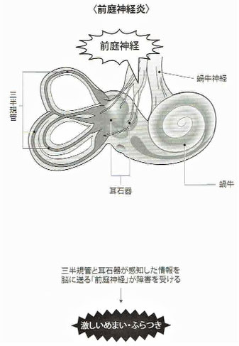 前庭神経炎