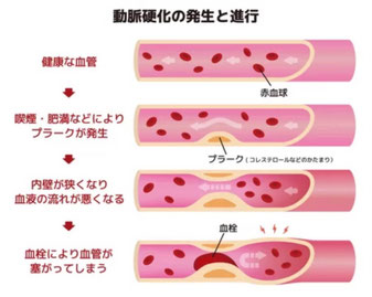 動脈硬化が進む流れ