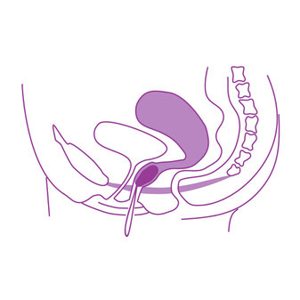 Vaginalkone von Elanee / Hilfsmittel zum Beckenbodentraining