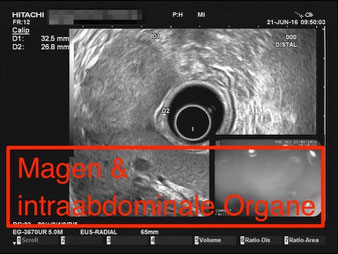 Endosonographie Pathologischer Befund Magen