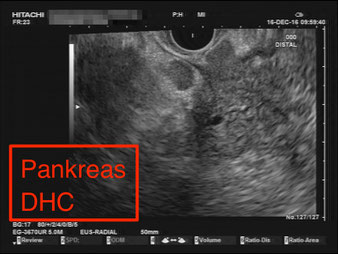 Endosonographie Pathologischer Befund Pankreas DHC