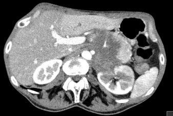 CT Abdomen Tumor Pankreas Niere