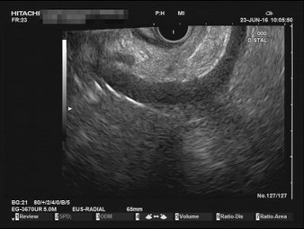 EUS Pancreas normal finding, pancreatic body, major pancreatic duct (duct of Wirsung), landmark splenic vein (Lienal vien), portal system.